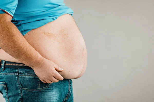 Sobrepeso Corpo Uma Pessoa Com Mãos Tocando Abdômen Conceito Obesidade — Fotografia de Stock