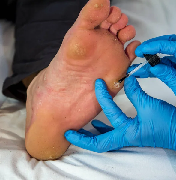 examination of a wart on a right foot by a doctor with blue gloves and medical utensils