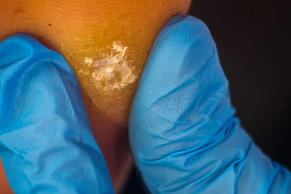 examination of a wart on a right foot by a doctor with blue gloves and medical utensils