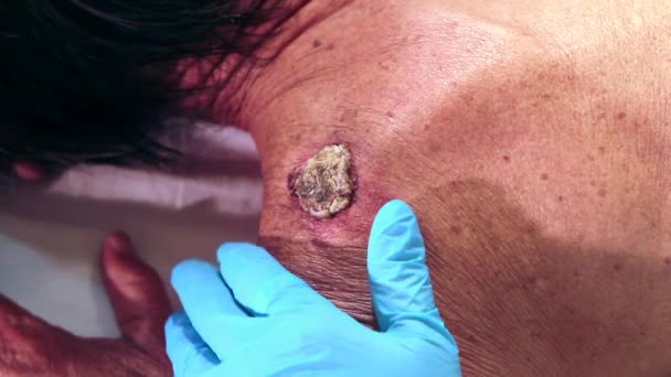 Examen de un tumor o melanoma en la piel de la parte posterior de un pazinte por un médico con guantes azules y utensilios médicos — Vídeos de Stock