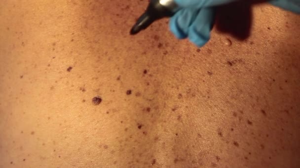 Control of moles by a doctor wearing blue gloves on a female patient circling the mole — Stock Video