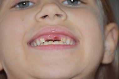 Bir çocuktan bir diş düştü.