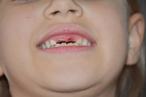 Dente Caiu Uma Criança — Fotografia de Stock