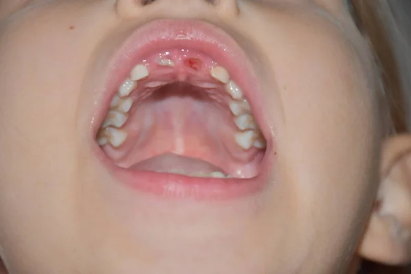 一颗从小孩身上掉下来的牙 — 图库照片