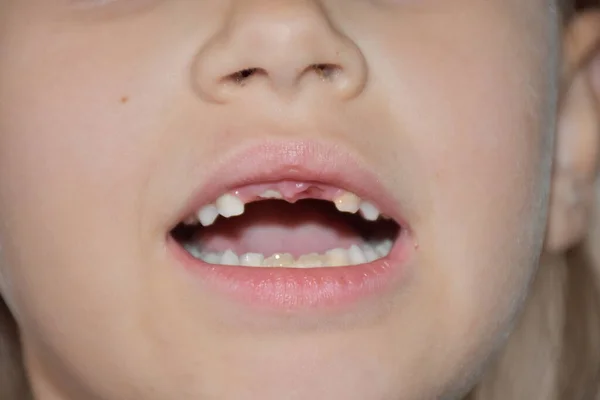 歯が子供から落ちた — ストック写真