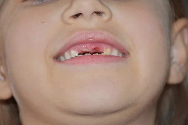 Dente Caiu Uma Criança — Fotografia de Stock