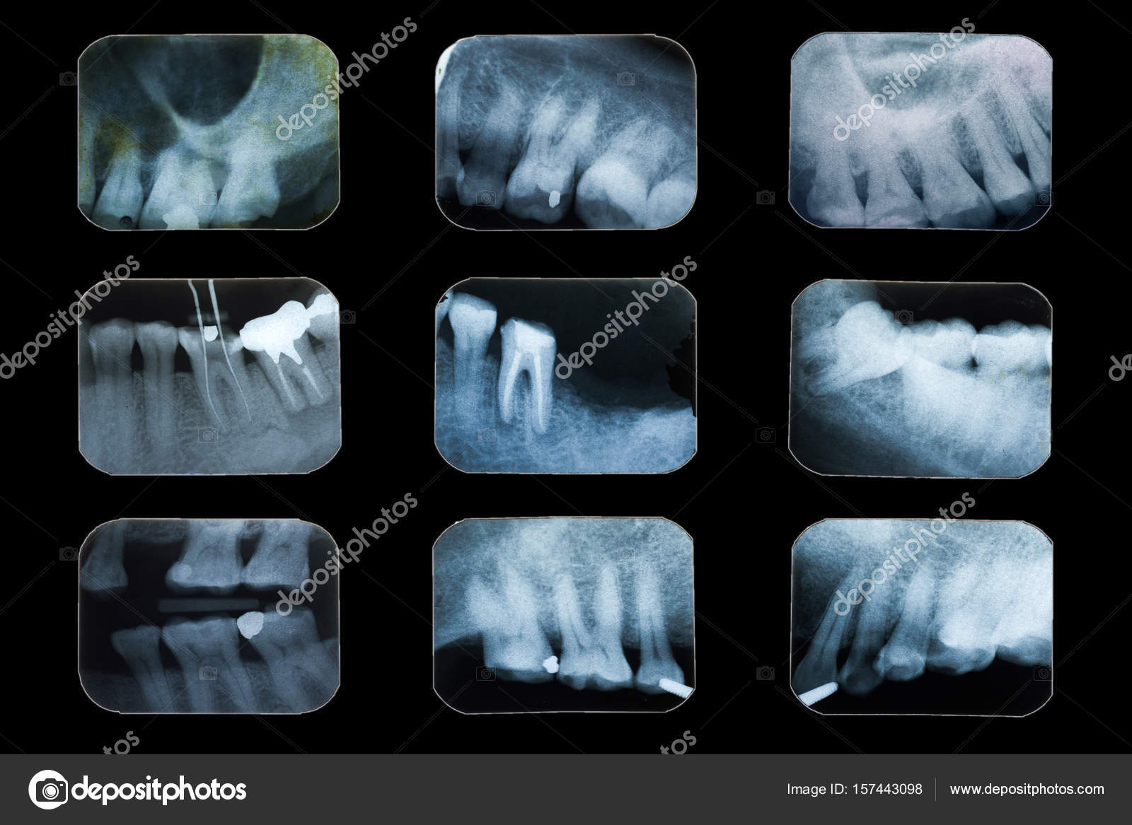 Dental X Ray Film