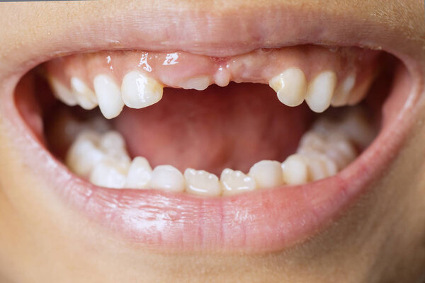 Unknown child showing her lost first milk teeth