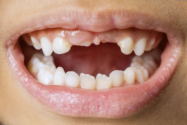 Desconhecido criança falta seus dentes de leite Fotografia De Stock