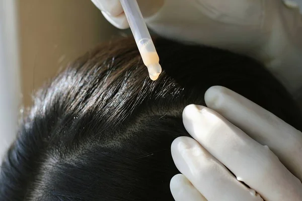 Médico que da un tratamiento en el cabello y el cuero cabelludo del paciente, Primer plano de la inyección de dermatólogo examen trastorno del cuero cabelludo . — Foto de Stock