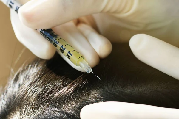 Médico inyectando en el cabello y el cuero cabelludo del paciente, Dermatólogo examen trastorno del cuero cabelludo. (Enfoque selectivo ) —  Fotos de Stock
