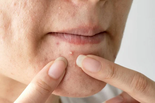 Akne Eiter, Nahaufnahme Foto von Akne neigender Haut, Frau quetscht ihren Pickel, entfernt Pickel aus ihrem Gesicht. — Stockfoto