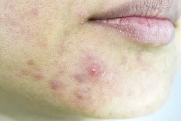 Kožní problém s akné onemocnění, zblízka žena tvář s bílými pupínky na bradě, menstruace breakout, jizva a mastný obličej, Krása koncepce. — Stock fotografie