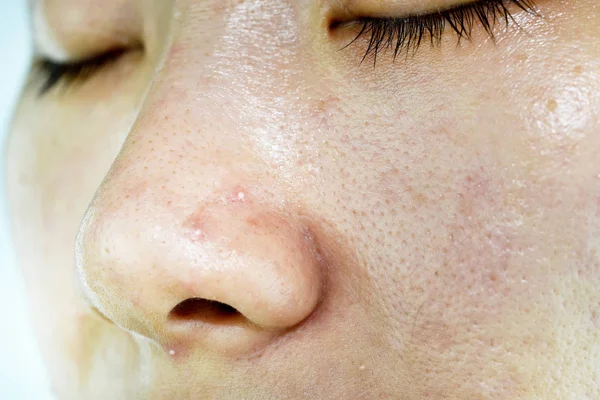 Problem skóry z chorobami trądziku, zbliżenie twarz kobiety z Whitehead pryszcze na nosie, Blizna i tłusta twarz tłusta, koncepcja piękna. — Zdjęcie stockowe