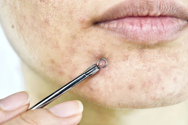 Skin problem with acne diseases, Close up woman face squeezing whitehead pimples on chin with acne removal tool, Scar and oily greasy face, Beauty concept. — Stock Photo, Image