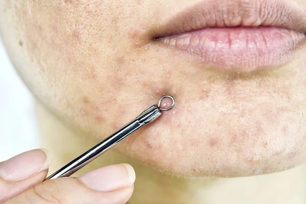 Problema de la piel con las enfermedades del acné, primer plano de la cara de la mujer apretando espinillas de cabeza blanca en la barbilla con la herramienta de eliminación de acné, cicatriz y grasa grasa facial, concepto de belleza . — Foto de Stock