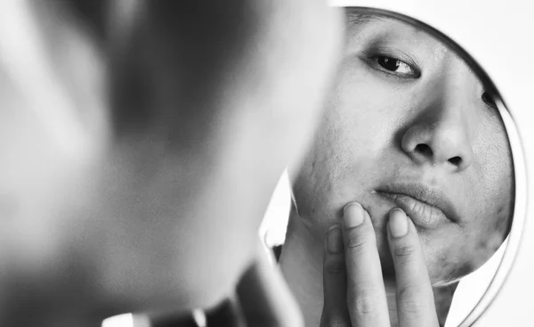 Hautprobleme und Akne-Narben, Frau blickt besorgt in den Spiegel wegen ihres Gesichtsproblems, Spiegelung, Schönheitskonzept. — Stockfoto