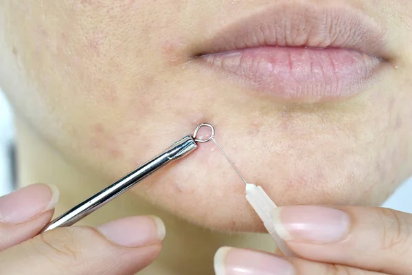 Problema de la piel con las enfermedades del acné, primer plano de la cara de la mujer apretando espinillas de cabeza blanca en la barbilla con la herramienta de eliminación de acné, cicatriz y grasa grasa facial, concepto de belleza . —  Fotos de Stock