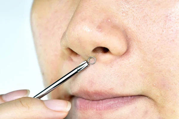 Skin problem with acne diseases, Close up woman face squeezing whitehead pimples on nose with acne removal tool, Scar and oily greasy face, Beauty concept. — Stock Photo, Image