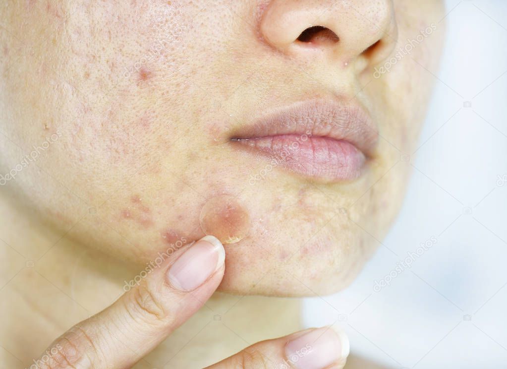Facial skin problem, Close up woman face with whitehead pimples and acne patch, Scar and oily greasy face, Beauty concept.