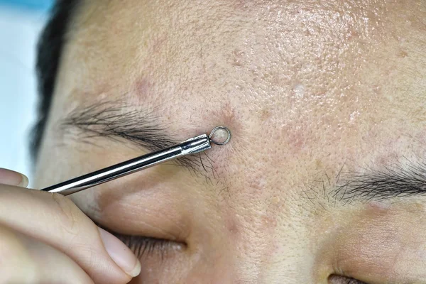 Problema de pele com doenças da acne, Fechar o rosto da mulher espremendo espinhas whitehead com ferramenta de remoção de acne, cicatriz e rosto oleoso gorduroso, conceito de beleza . — Fotografia de Stock