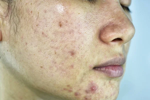 Problema de la piel con las enfermedades del acné, Primer plano de la cara de la mujer con granos de la cabeza blanca, ruptura de la menstruación, cicatriz y la cara grasa grasa grasa, concepto de belleza . — Foto de Stock