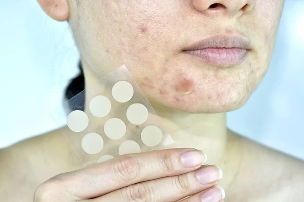 Gezichtshuid probleem met acne patch, close-up vrouw gezicht met whitehead puistjes en absorberen van pad, litteken acne en vette vette gezicht, Beauty concept. — Stockfoto