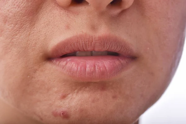 Problema Della Pelle Con Malattie Dell Acne Primo Piano Faccia — Foto Stock