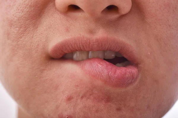 Problema Enfermedad Piel Labio Seco Agrietado Morder Los Labios Cicatriz —  Fotos de Stock