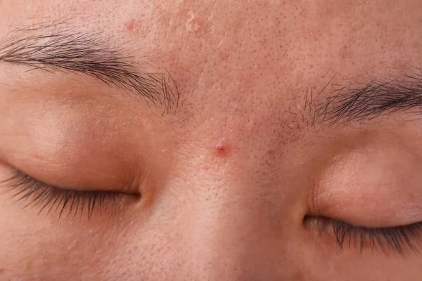 にきび疾患の皮膚の問題 鼻の上に白い頭のにきびと女性の顔を閉じます 傷跡と油性の脂っこい顔 美容コンセプト — ストック写真