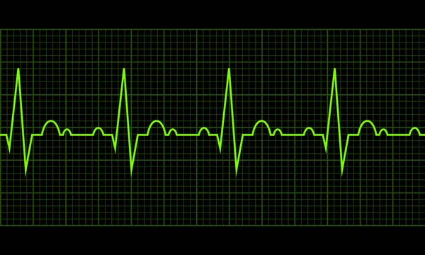 Oregelbundna hjärtslag. Kardiogram. Hjärt cykel — Stock vektor