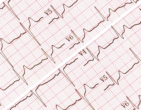 Kardiogram bilder. Några forskningsresultat från Cu — Stockfoto