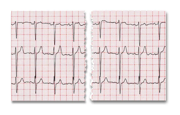 Cardiografía Resultado Investigación Rompe Por Mitad Aísla Sobre Fondo Blanco — Foto de Stock