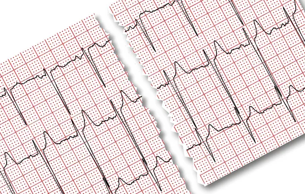 Kardiogram Resultatet Forskning Slits Hälften Det Isolerad Vit Bakgrund — Stockfoto