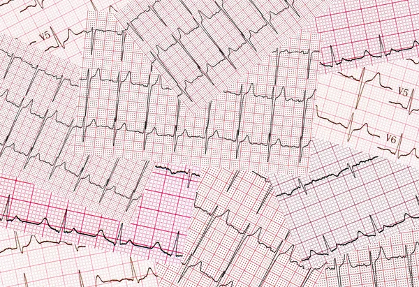Kardiogram Sok Nyomtatott Eredménye Kaotikus Absztrakt Háttér — Stock Fotó
