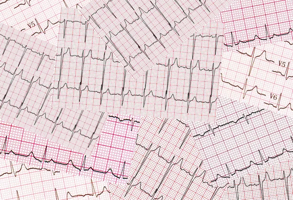 Muchos Resultados Impresos Del Cardiograma Son Escasos Caóticamente Fondo Abstracto — Foto de Stock