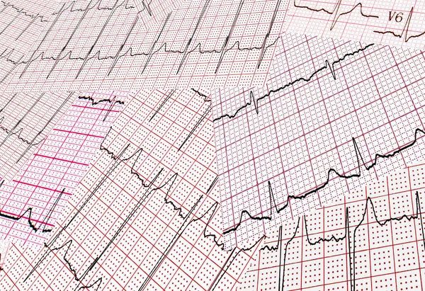 Muchos Resultados Impresos Del Cardiograma Son Escasos Caóticamente Fondo Abstracto — Foto de Stock
