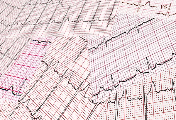 Kardiogram Sok Nyomtatott Eredménye Kaotikus Absztrakt Háttér — Stock Fotó