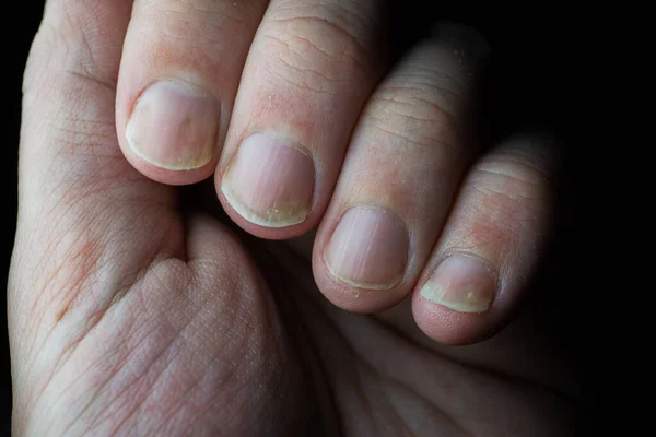 건선은 손톱 과 피부에 영향을 미치는 자가면 역질환입니다. 어두운 배경에 있는 건선 손톱을 가까이 서 본 모습. — 스톡 사진