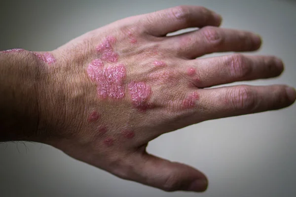 Psoriasis Autoimmun Hudsjukdom Mannens Hand Med Fickor Psoriasis Lesion Grå — Stockfoto
