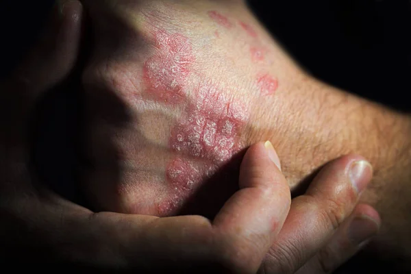 Psoriasis Una Enfermedad Autoinmune Humana Hombre Sostiene Una Mano Una — Foto de Stock