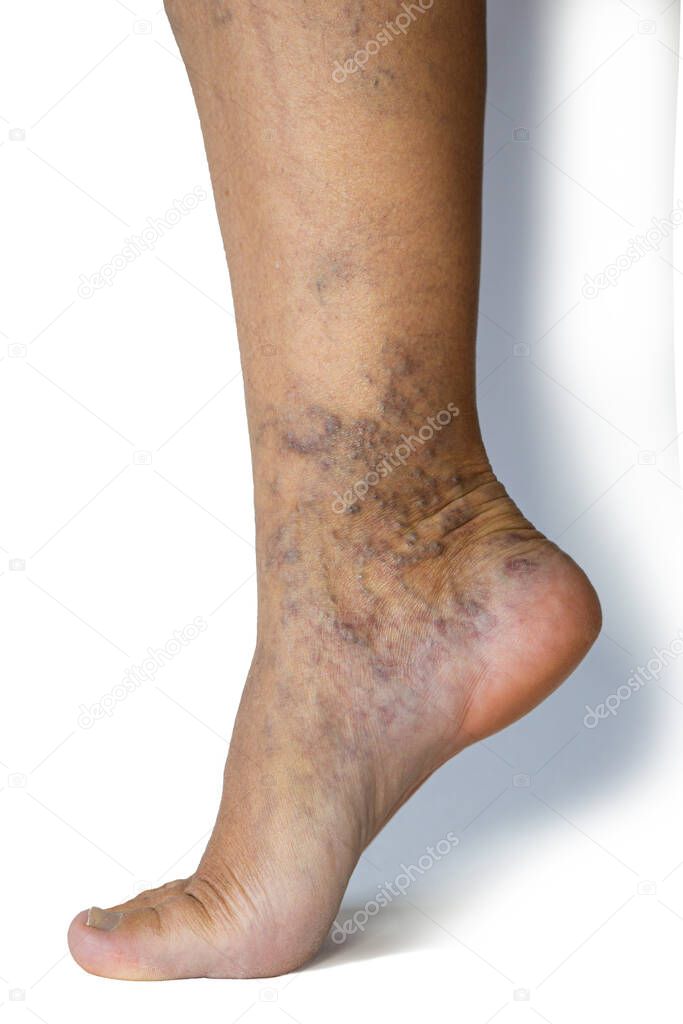 Varicose veins on a female legs. Phlebology problem. Woman's health.
