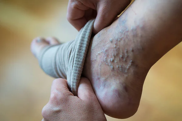 Žena Přitlačí Křečovými Žilami Nohu Punčochu Prevence Křečových Žil Kompresní — Stock fotografie