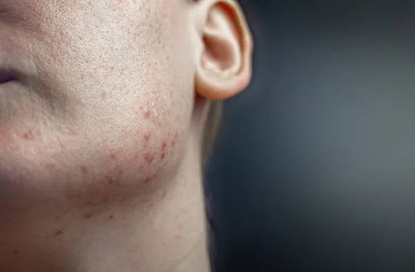 Acne Hakan Demodecosis Fästing Huden Flickas Ansikte Patient Vid Utnämningen — Stockfoto