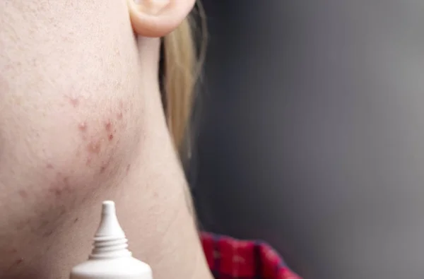 Acne Kin Demodecose Tik Huid Van Het Gezicht Van Een — Stockfoto