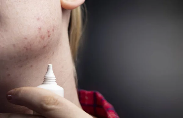 Acne Kin Demodecose Tik Huid Van Het Gezicht Van Een — Stockfoto