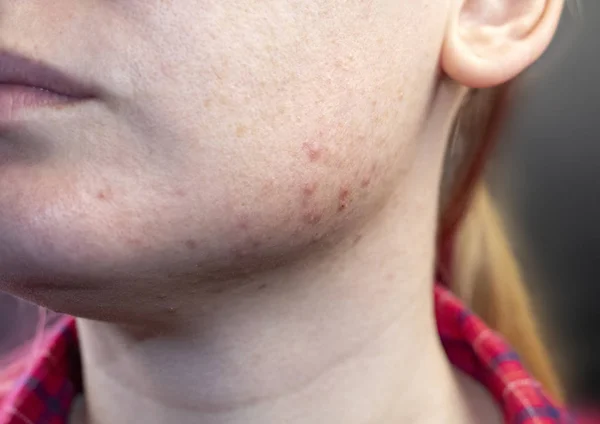 下巴上的痤疮 脱落感在女孩脸上的皮肤上打勾 一位皮肤科医生的预约病人 皮肤与美的概念 — 图库照片
