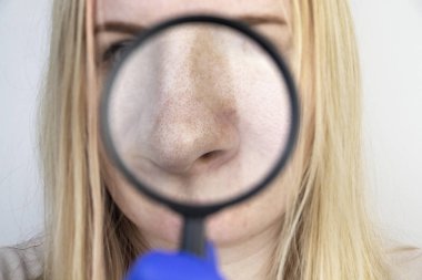 Genişletilmiş gözenekler, siyah noktalar, sivilceler, burun üzerinde yakın plan rosacea. Bir kadın bir doktor tarafından muayene ediliyor. Dermatolog deriyi büyüteçle inceliyor, büyüteçle.