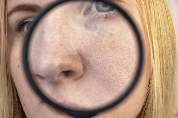 Genişletilmiş gözenekler, siyah noktalar, sivilceler, burun üzerinde yakın plan rosacea. Bir kadın bir doktor tarafından muayene ediliyor. Dermatolog deriyi büyüteçle inceliyor, büyüteçle.