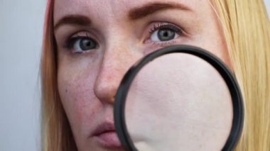 Genişletilmiş rosacea, gözenekler, siyah noktalar, sivilceler, burun üstüne yakın plan. Bir kadın bir doktor tarafından muayene ediliyor. Dermatolog deriyi büyüteçle inceliyor, büyüteçle. 